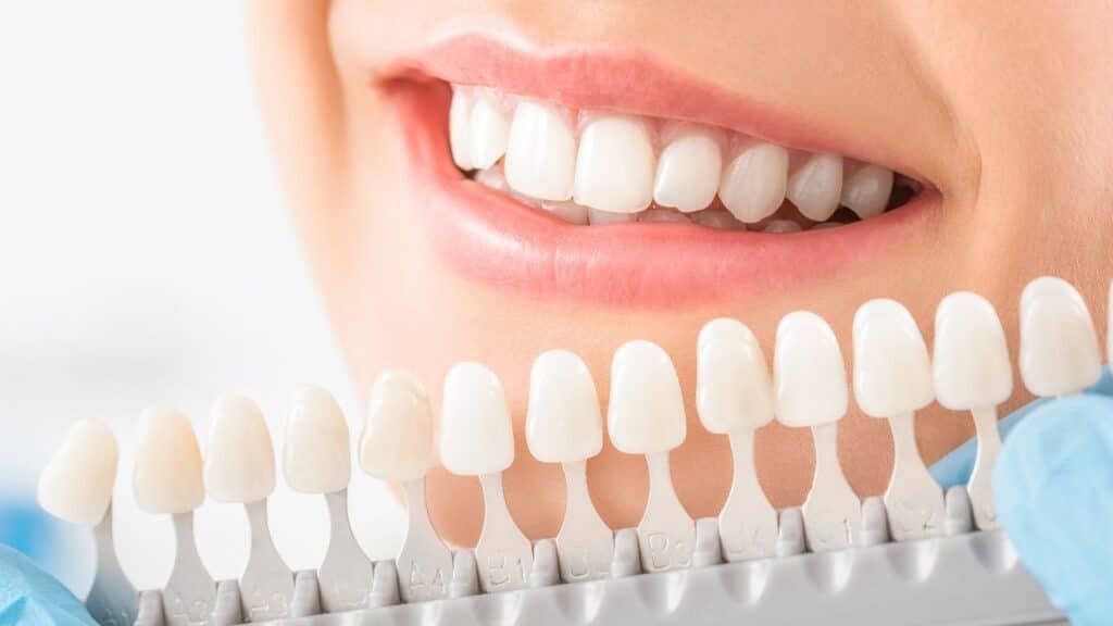 teeth whitening in brighton