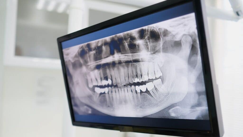 root canal in brighton