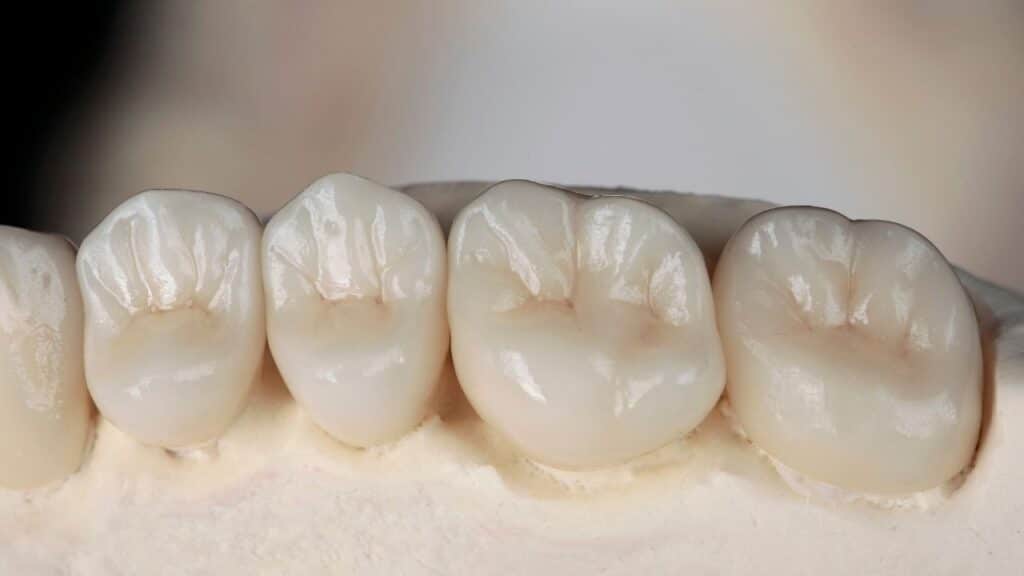 Crowns and bridges in brighton